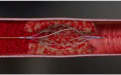 Thrombolex Receives FDA Clearance for Bashir Endovascular Catheters