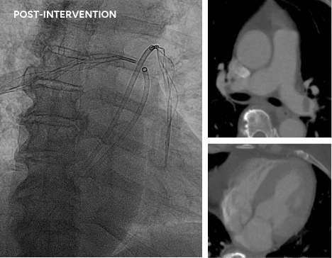 Post-intervention RESCUE protocol - total of 14mg r-tPA (7mg per lung)
