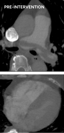 Pre-intervention Bilateral PE case